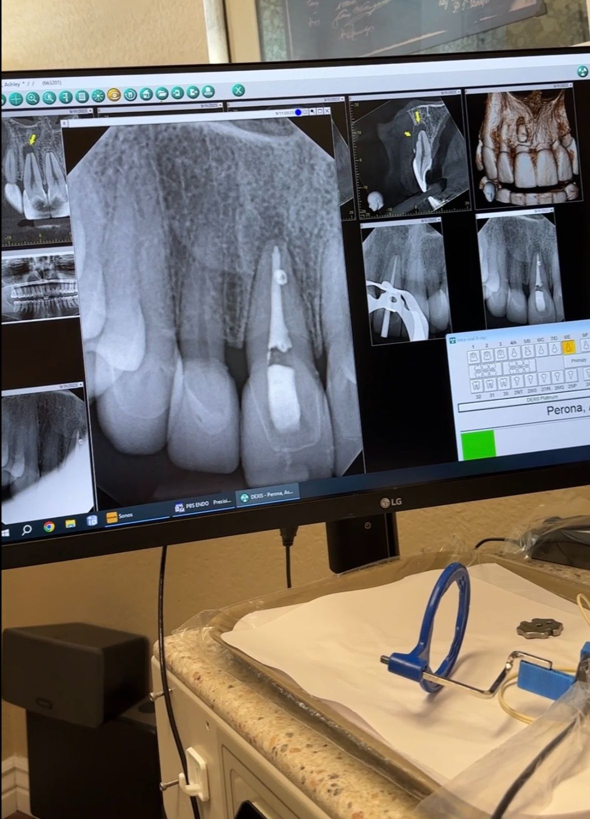 Root Canal in Scottsdale, Arizona